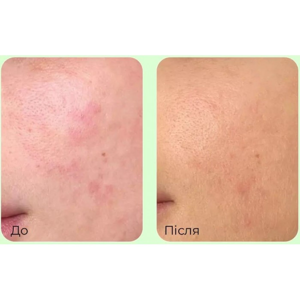 Успокаивающий крем для чувствительной и проблемной кожи Medi-Peel Young Cica PDRN Trouble Soothing Cream, 80 мл 2116 фото